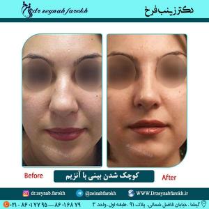 کوچک شدن بینی با آنزیم 2 (1)