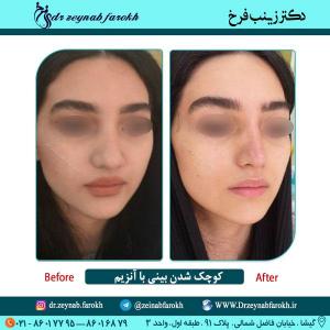 کوچک شدن بینی با آنزیم 3