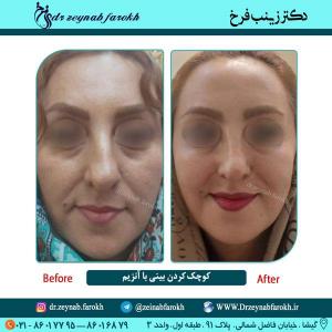 کوچک شدن بینی با آنزیم 4