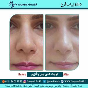 کوچک شدن بینی با آنزیم 5
