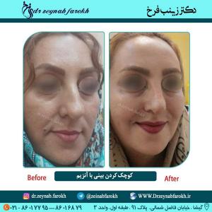 کوچک شدن بینی با آنزیم 5 (1)