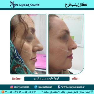 کوچک شدن بینی با آنزیم 6