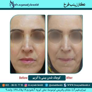 کوچک شدن بینی با آنزیم 7