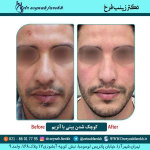 کوچک شدن بینی با آنزیم 8