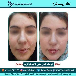 کوچک شدن بینی با تزریق آنزیم 1