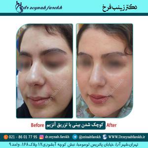 کوچک شدن بینی با تزریق آنزیم 2