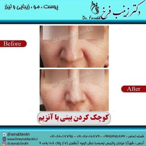 کوچک کردن بینی با آنزیم 5