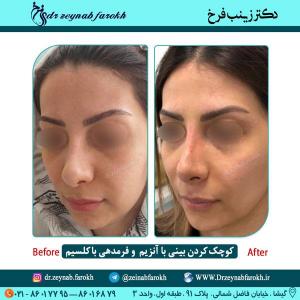 کوچک کردن بینی با آنزیم و فرمدهی با کلسیم