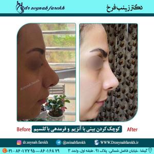 کوچک کردن بینی با آنزیم و فرمدهی با کلسیم 1