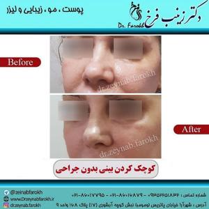 کوچک کردن بینی بدون جراحی
