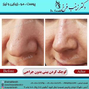 کوچک کردن بینی بدون جراحی 2