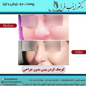 کوچک کردن بینی بدون جراحی 4