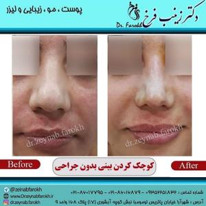 کوچک کردن بینی بدون جراحی 5