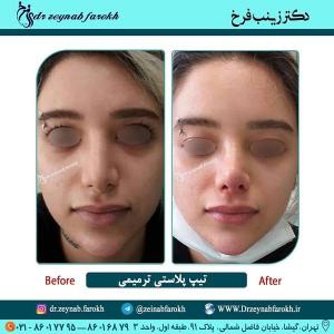 تیپ پلاستی ترمیمی 249