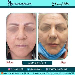جمع کردن پره بینی 239