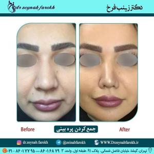 جمع کردن پره بینی 259