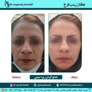 جمع کردن پره بینی 281
