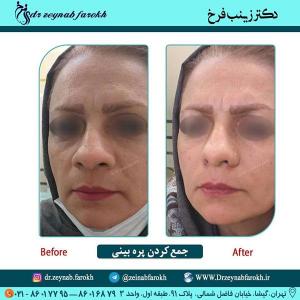 جمع کردن پره بینی 282