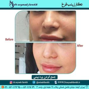 جمع کردن پره بینی 286