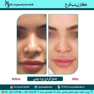 جمع کردن پره بینی 287