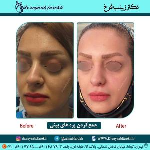 جمع کردن پره های بینی 335