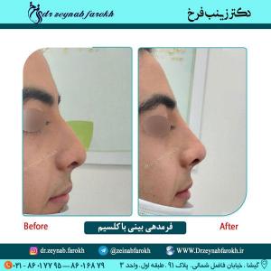 فرمدهی بینی با کلسیم 52