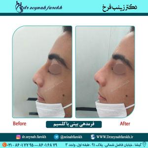 فرمدهی بینی با کلسیم 53