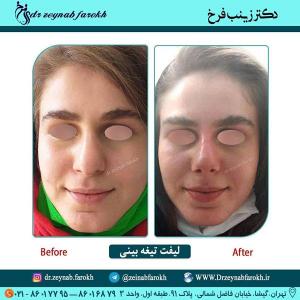 لیفت تیغه بینی 270