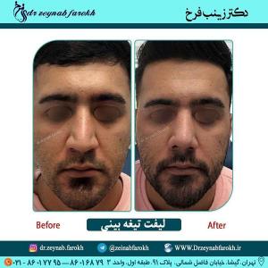 لیفت تیغه بینی 300