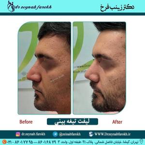 لیفت تیغه بینی 301