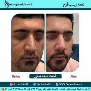 لیفت تیغه بینی 302