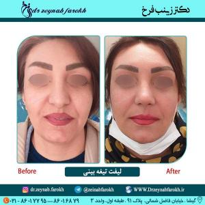 لیفت تیغه بینی 32
