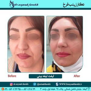 لیفت تیغه بینی 33