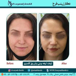 لیفت تیغه بینی و تزریق کلسیم 236