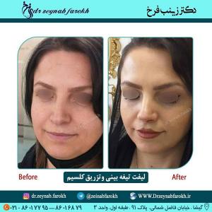 لیفت تیغه بینی و تزریق کلسیم 237