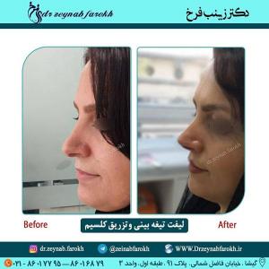 لیفت تیغه بینی و تزریق کلسیم 238