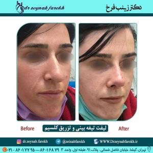 لیفت تیغه بینی و تزریق کلسیم 242