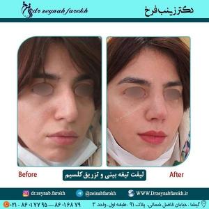 لیفت تیغه بینی و تزریق کلسیم 248