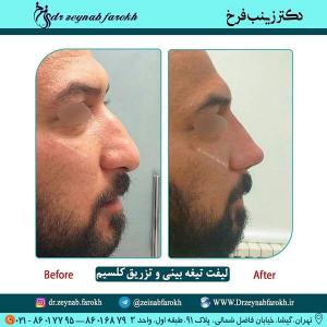 لیفت تیغه بینی و تزریق کلسیم 255 (1)