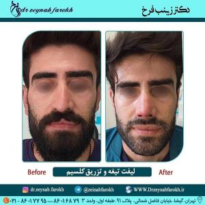 لیفت تیغه بینی و تزریق کلسیم 256