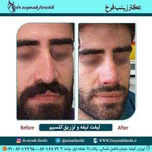 لیفت تیغه بینی و تزریق کلسیم 257