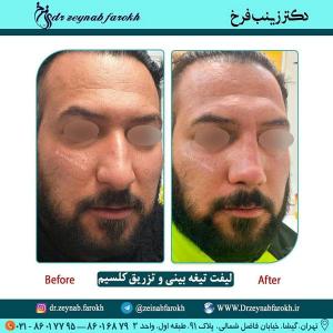 لیفت تیغه بینی و تزریق کلسیم 257 (1)