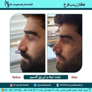 لیفت تیغه بینی و تزریق کلسیم 258