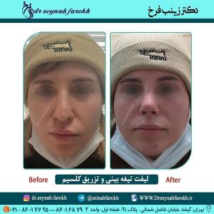 لیفت تیغه بینی و تزریق کلسیم 327