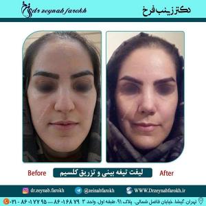 لیفت تیغه بینی و تزریق کلسیم 330