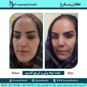 لیفت تیغه بینی و تزریق کلسیم 331