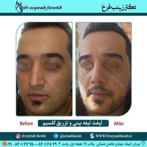 لیفت تیغه بینی و تزریق کلسیم 332