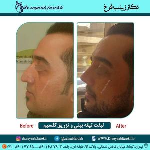 لیفت تیغه بینی و تزریق کلسیم 333