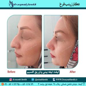 لیفت تیغه بینی و تزریق کلسیم 54