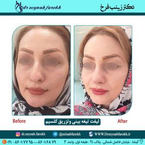 لیفت تیغه بینی و تزریق کلسیم 56